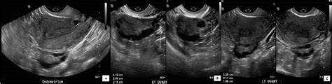 Transvaginal Ultrasound Pelvis Images [a] Sagittal View Of The Uterus