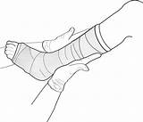 Cast Leg Clipart Arm Clip Drawing Cliparts Library Advertisement sketch template