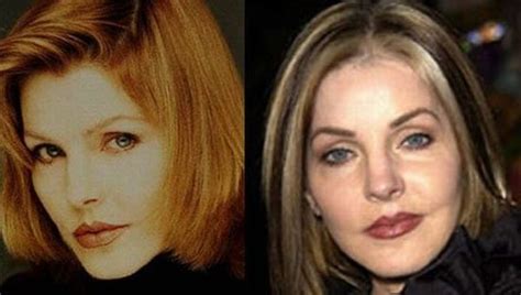 stars before and after plastic surgery 47 pics