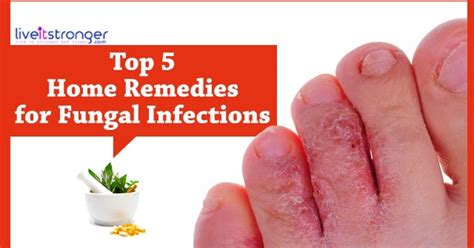 types and home remedies for fungal infection live it healthy