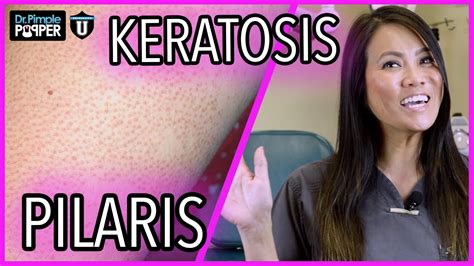What Are These Bumps On My Skin Keratosis Pilaris With Dr Sandra