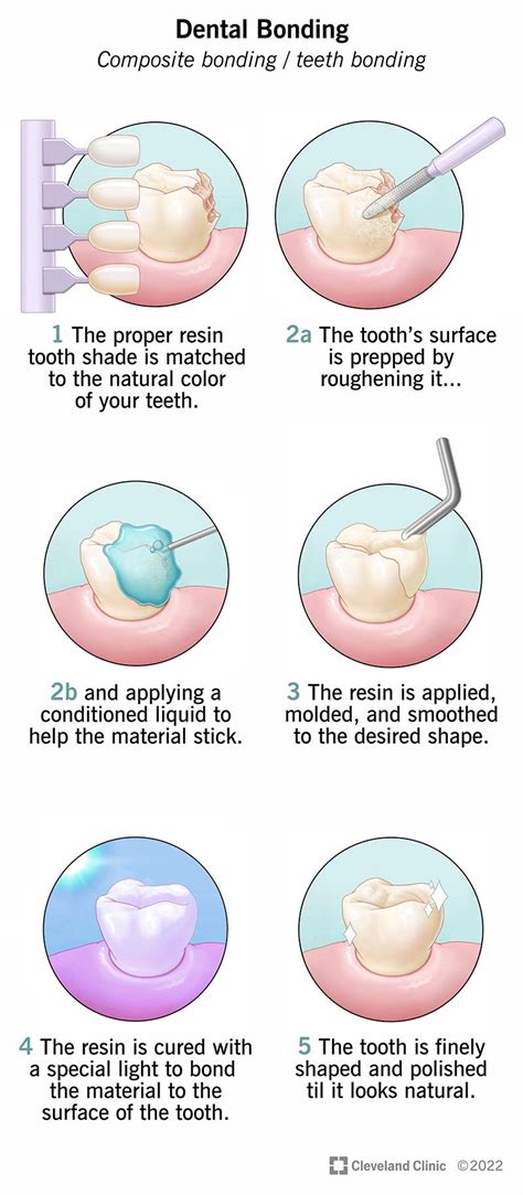 dental bonding   teeth bonding   expect
