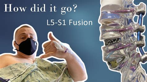 fusion  surgery  fusion youtube