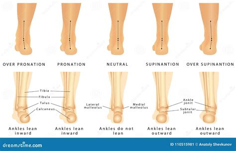 foot deformation stock vector illustration  deformation