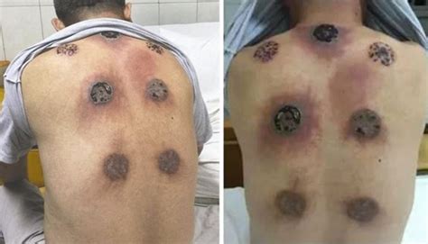 chinese man s cupping therapy goes horribly wrong after going for an entire month