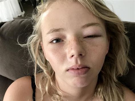 kmart eye mask ‘blinds teen with allergic reaction herald sun