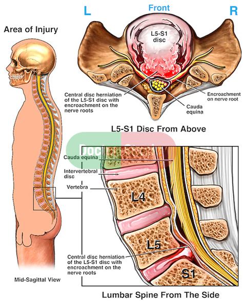 massive   lumbar disc herniation  nerve root impingement doctor stock