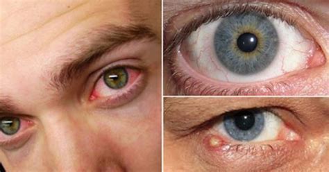 oto  popularnych chorob ktore latwo rozpoznac po spojrzeniu  oczy