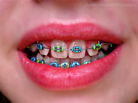 Braces Colors For Girls Posted By Autumn At 5 13 Pm Braces