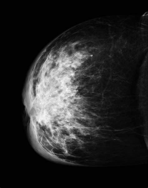 inflammatory breast carcinoma buyxraysonline