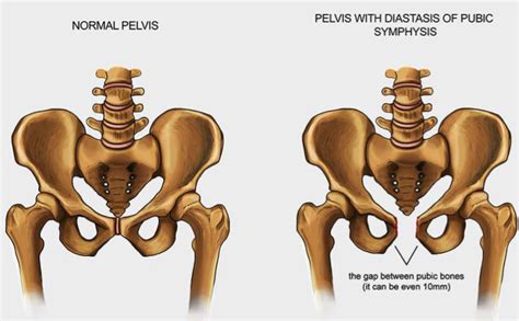 Symphysis Pubis Dysfunction Musculoskeletal Physiotherapy Australia