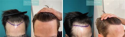 grafts hair transplant