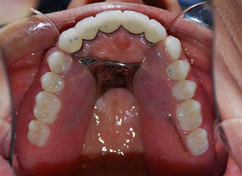 dentures  avenue dental