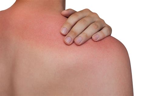 What To Do If You Get Sunburnt Live Better
