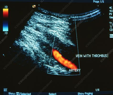 doppler ultrasound showing deep vein thrombosis stock image  science photo library