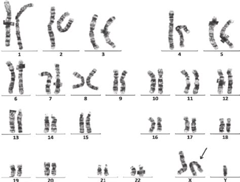 Karyotype Of The Patient Shows The 47 Xxy Pattern Download