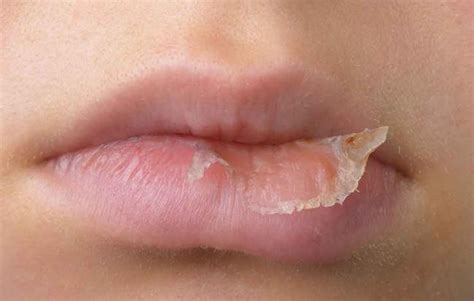 What Are The Remedies For Hives And Eczema On The Lips