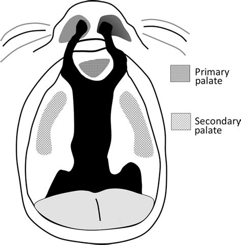 Radiology Of Cleft Lip And Palate Imaging For The Prenatal Period And