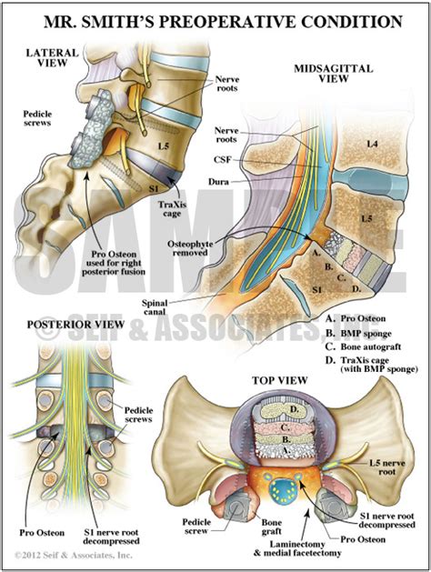 lumbar nerve root case study sa medical graphics