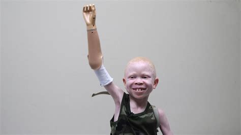 albinism videos at abc news video archive at