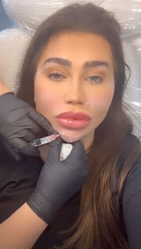 Lauren Goodger Has Injections In Her Face After Fans Begged Her To Stop