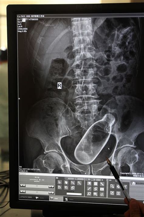 Shocking Hospital X Ray Shows Man With Bottle Stuck Inside