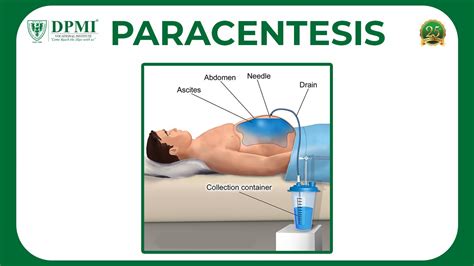 Paracentesis Peritoneal Fluid Analysis Or Ascitic Fluid Analysis