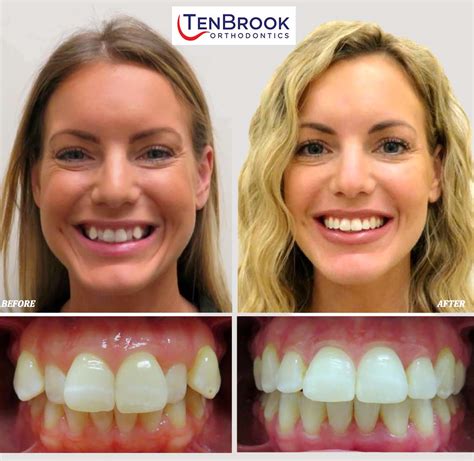 The Tenbrook Orthodontics Smile