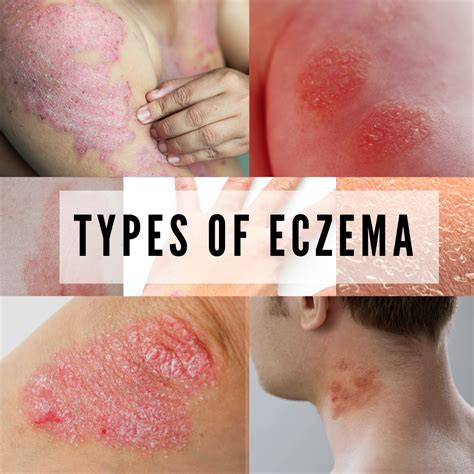 types  eczema   symptoms banish