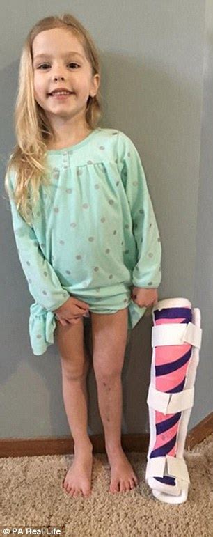 Mother Reveals Her Four Year Old Had To Have Her Leg Broken Three Times