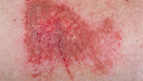 Friction Burn On Penis Symptoms Treatment And Prevention