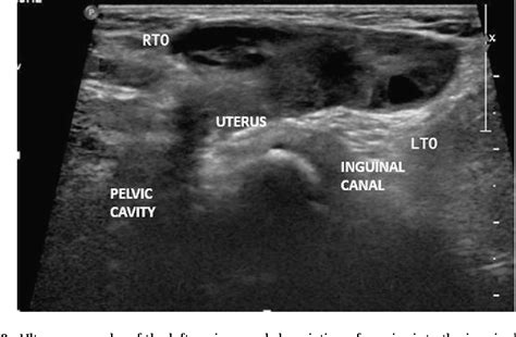 Scrotal Hernia Ultrasound