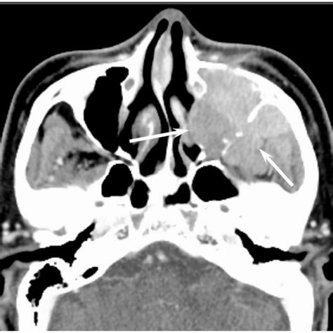 sinonasal undifferentiated carcinoma    nasal cavity