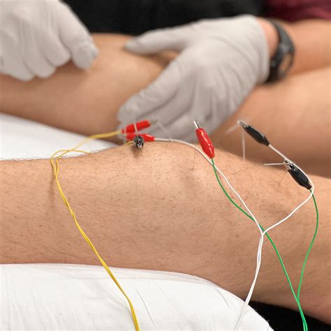 dry needling therapy   chronic pain ms physical therapy