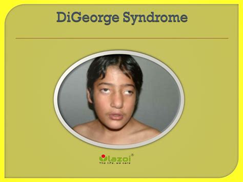 digeorge syndrome powerpoint    id