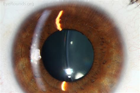 phakic intraocular lenses  high myopia