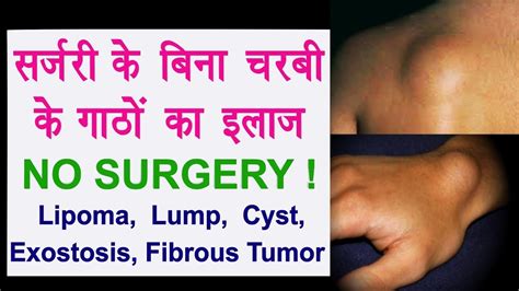 lipoma  surgery  il fat lump fibrous tumor exostosis cyst