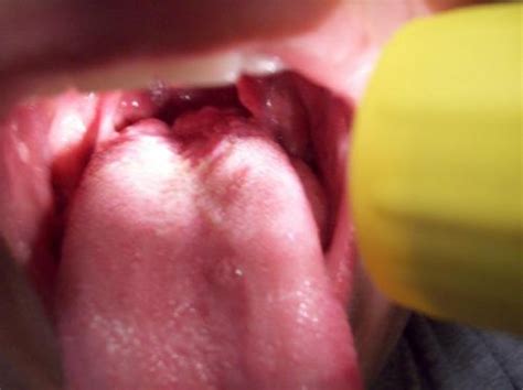 red bumps on tongue and throat bumps on back of tongue sore throat image search results