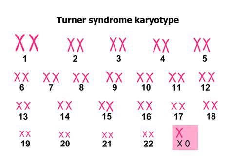 Turner Syndrom — Fertiprotekt