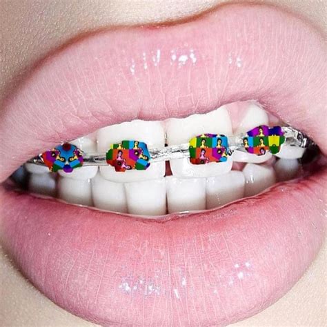 different swag diy braces dental braces teeth braces dental care