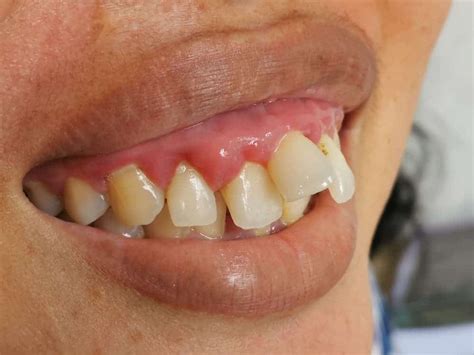 maloklusi gigi berantakan obat penyebab gejala dll  sehat