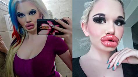 Woman Might Have Biggest Lips In The World After 20 Procedures Iheart