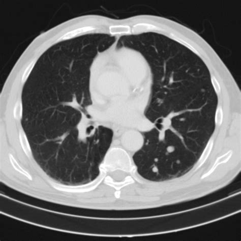 A And B Chest Ct Showing Multiple Lung Nodules And Enlarged Lymph