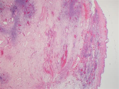 pathology outlines large solitary luteinized follicular cyst of