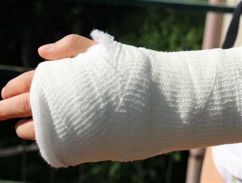 plaster cast advice    speed  recovery