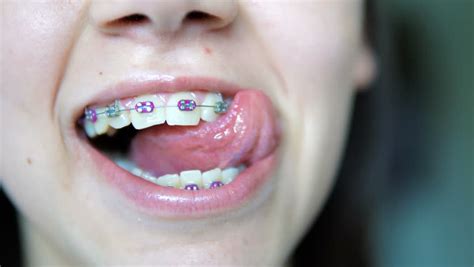 happy girl with braces stock footage video 13546280 shutterstock