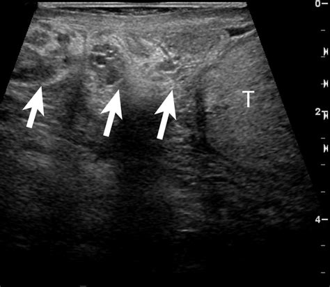 Ultrasound Evaluation Of Acute Scrotal Pain Iame