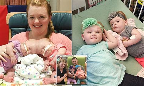 Once Conjoined Twins Are Going Home For Thanksgiving