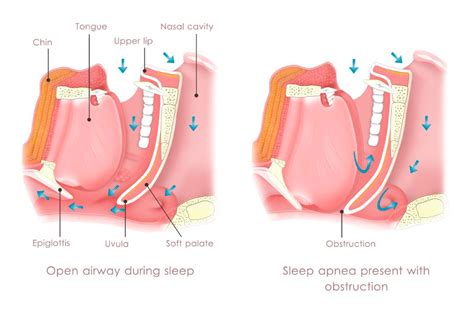 snoring and sneap program treatment wemed health
