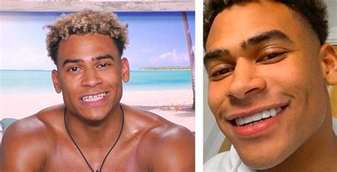 Love Island The Islanders With The Most Shocking Teeth Transformations